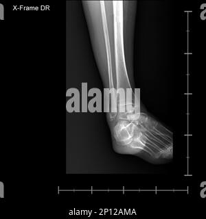 X-ray tarsal and ankle front Stock Photo