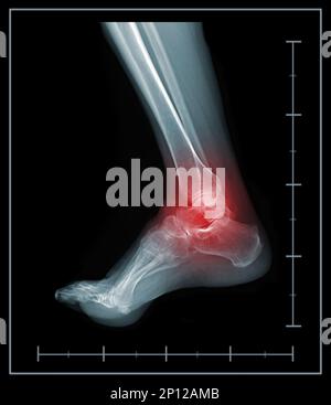 X-ray foot painful ankle area Stock Photo