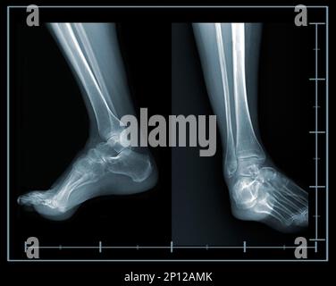 X-ray foot lateral and front view Stock Photo