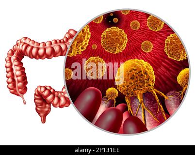 Colon cancer growth or colorectal malignant tumor concept as a medical illustration of a large intestine with a Metastatic Carcinogenic disease Stock Photo