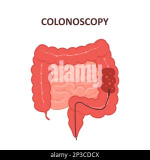 Colonoscopy procedure. Intestine exam and treatment. Colon polypectomy concept. Prevention of cancer. Vector illustration in flat cartoon style Stock Vector