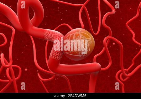 Aneurysm treat with mesh stent and coils - 3d illustration isometric view Stock Photo
