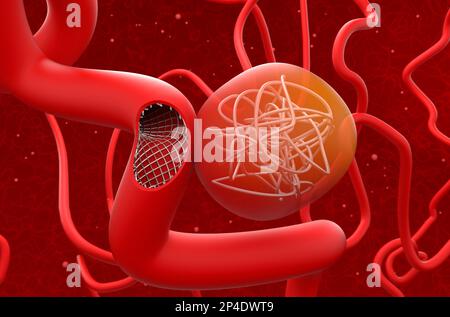 Aneurysm treat with mesh stent and coils (section) - 3d illustration closeup view Stock Photo