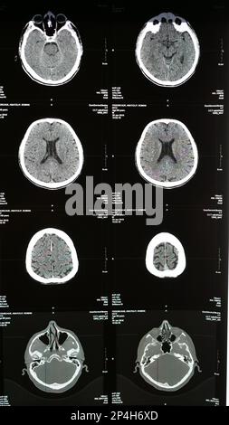 Magnetic resonance imaging of the brain from different sides, traumatic ...