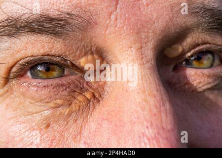 men's eyes with fat accumulations, Xanthelasmas Stock Photo
