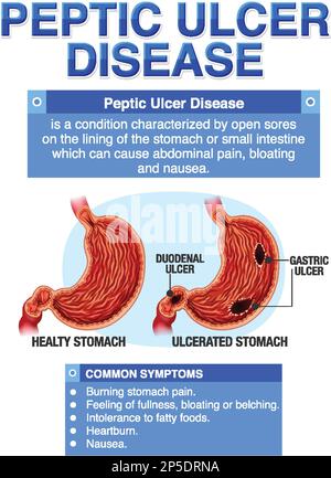Peptic Ulcer Disease Explained Infographic illustration Stock Vector