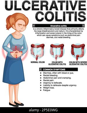 Ulcerative Colitis Symptoms Infographic Illustration Stock Vector Image 