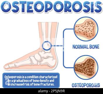 Informative poster of Osteoporosis human bone illustration Stock Vector