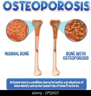 Informative poster of Osteoporosis human bone illustration Stock Vector