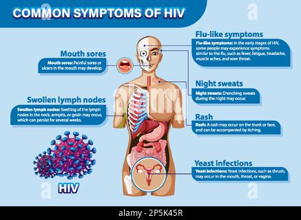 Informative Poster Of Common Symptoms Of Hiv Illustration Stock Vector 