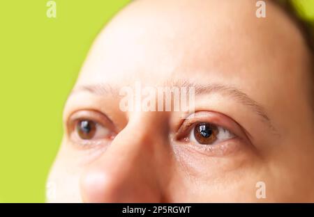 Barley disease in the eye. Sore eyelid. Stock Photo