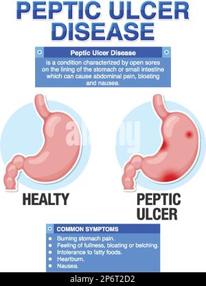 Peptic Ulcer Disease Explained Infographic illustration Stock Vector