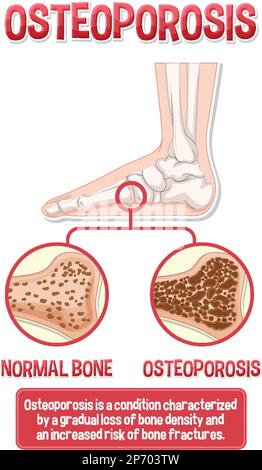 Informative poster of Osteoporosis human bone illustration Stock Vector