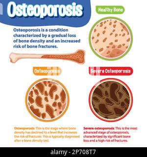 Informative poster of Osteoporosis human bone illustration Stock Vector