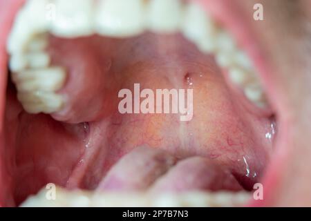 Back of the throat, roof of the mouth macro close up view of Caucasian male pharynx. Stock Photo