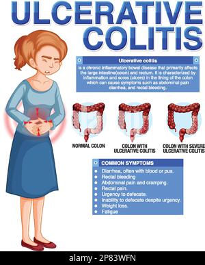 Ulcerative Colitis Symptoms Infographic illustration Stock Vector Image ...