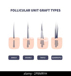 Hair graft types set for hair transplantation Stock Vector