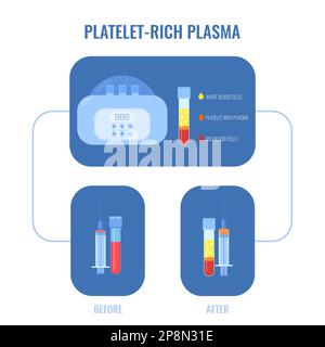 Human blood plasma after centrifugation infographic poster Stock Vector