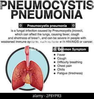 Informative poster of Pneumocystis Pneumonia illustration Stock Vector ...