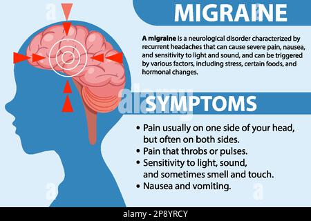 Informative poster of Migraine illustration Stock Vector Image & Art ...