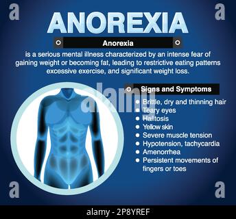 Informative poster of Anorexia eating disorder illustration Stock Vector