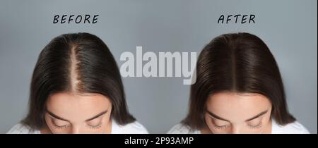 Woman with hair loss problem before and after treatment on grey background, collage. Visiting trichologist Stock Photo
