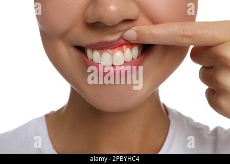 Young woman showing inflamed gums, closeup view Stock Photo
