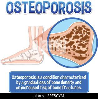 Informative poster of Osteoporosis human bone illustration Stock Vector