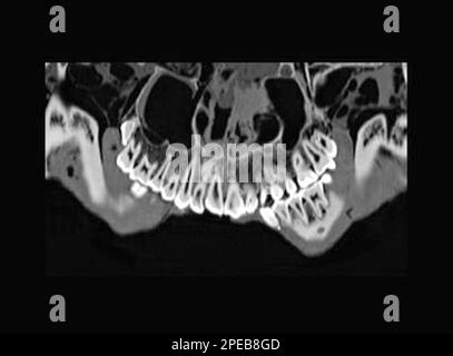 Egypt, CT scan of Tutankhamun Stock Photo - Alamy