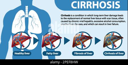 Informative Poster Of Alcoholic Liver Disease Cirrhosis Illustration ...