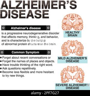 Informative poster of Alzheimers disease illustration Stock Vector ...