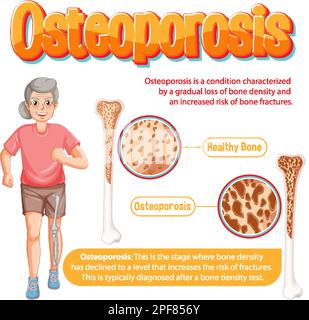 Informative poster of Osteoporosis human bone illustration Stock Vector