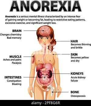 Informative poster of Anorexia eating disorder illustration Stock Vector