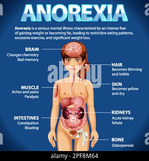 Informative poster of Anorexia eating disorder illustration Stock Vector