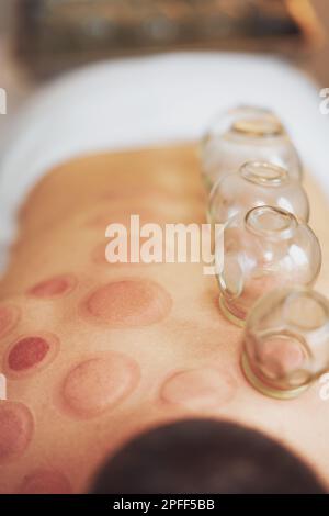 A picture of a man having cupping therapy Stock Photo