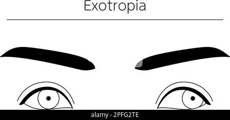 Medical illustrations, diagrammatic line drawings of eye diseases, strabismus and exotropia, Vector Illustration Stock Vector