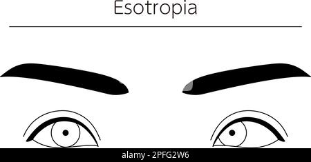 Medical illustrations, diagrammatic line drawings of eye diseases, strabismus and esotropia, Vector Illustration Stock Vector