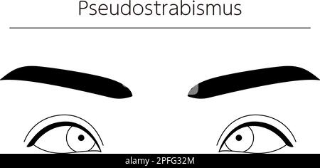 Medical illustrations, diagrammatic line drawings of eye diseases, strabismus and pseudostrabismus, Vector Illustration Stock Vector