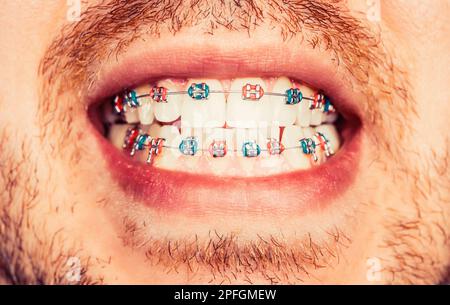 Dental concept. Man with braces. Bracket system in smiling mouth, macro photo teeth, close-up lips, macro shot, dentist Stock Photo