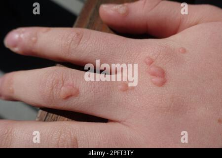 Warts on Hand Stock Photo