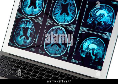 Magnetic resonance imaging of the brain close up. MRI Stock Photo - Alamy
