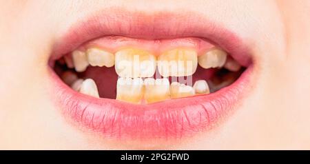 Kid patient open mouth showing cavities teeth decay. Child smile and show her crowding tooth. Close up of unhealthy baby teeths Stock Photo