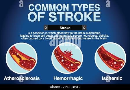 Informative poster of common types of stoke illustration Stock Vector