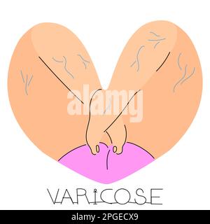 Feet in the shape of a heart on a white background. Vector illustration of varicose veins. The concept of treatment and care of the feet. Flat style s Stock Vector