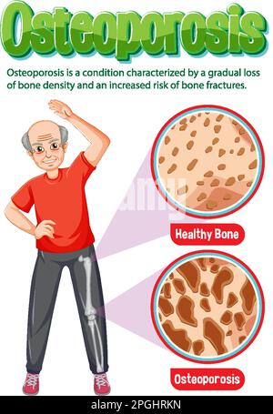 Informative poster of Osteoporosis human bone illustration Stock Vector