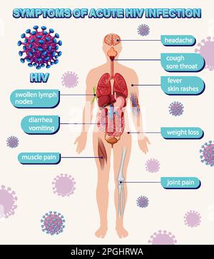 Informative poster of common symptoms of HIV illustration Stock Vector