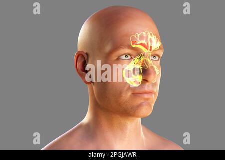 Sinus infection, or sinusitis, computer illustration. The sinuses are ...