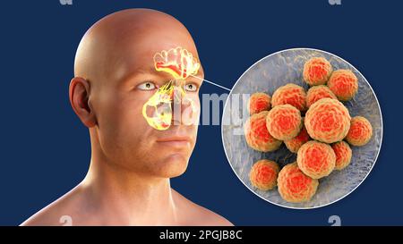 Staphylococcus aureus bacteria as a cause of sinusitis. Computer ...