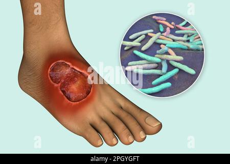 Buruli ulcer and Mycobacterium ulcerans, illustration Stock Photo