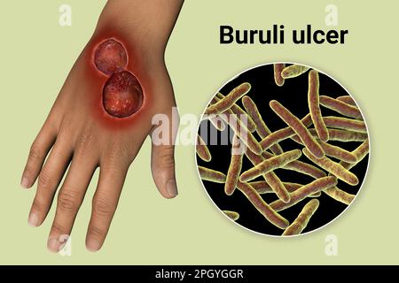 Buruli ulcer and Mycobacterium ulcerans, illustration Stock Photo